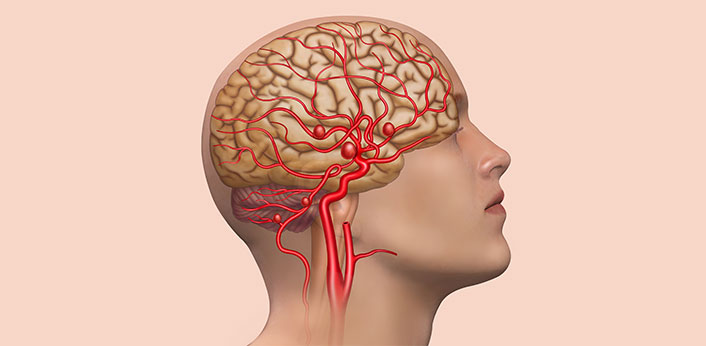 italo-teles-imagem-interna-Aneurismas-Cerebrais