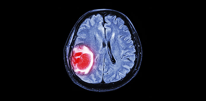 italo-teles-imagem-interna-Glioblastoma-Multiforme